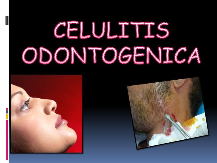 Causas Y Complicaciones De La Celulitis Facial Odontógena En – MSQVWU