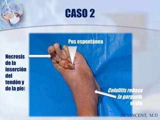 CASO 2Pus espontáneaNecrosis de la insercióndel tendón y de la pielCelulitis rebasa la gargantael pieDr. VINCENT,  M.D