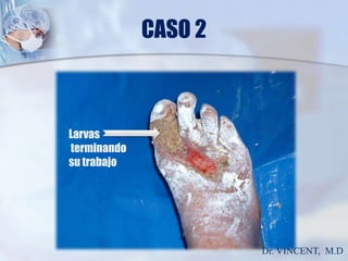 CASO 2Larvas terminando su trabajoDr. VINCENT,  M.D