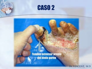 CASO 2Tendón extensor propiodel dedo gordoDr. VINCENT,  M.D