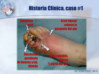 Historia Clínica, caso #1Gangrena secaGran Edema rebasa la garganta del pieSecreción purulentade huesos y tej. blandoGran celulitis, abarca¾ parte del pieDr. VINCENT,  M.D
