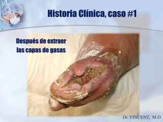 Historia Clínica, caso #1Después de extraer las capas de gasasDr. VINCENT,  M.D