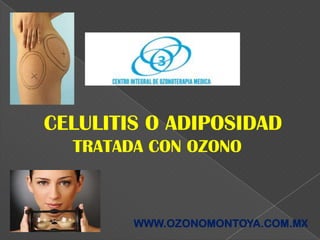  CELULITIS O ADIPOSIDAD TRATADA CON OZONO WWW.OZONOMONTOYA.COM.MX 
