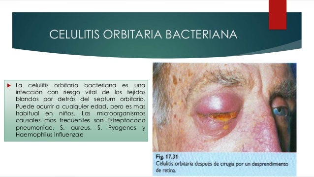 Celulitis orbitaria