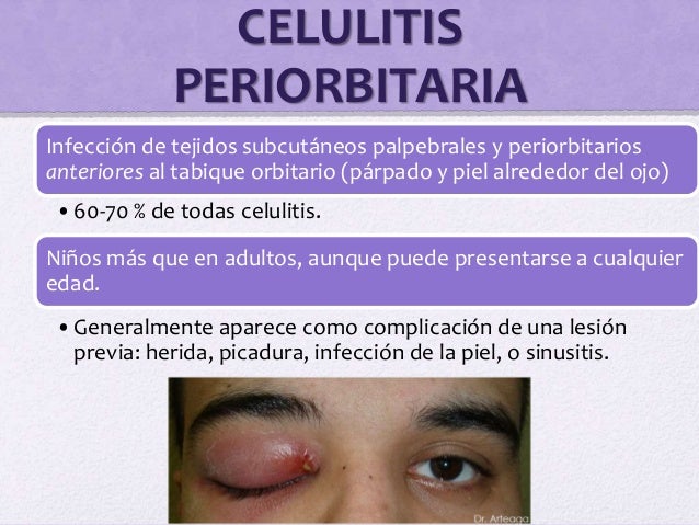 Celulitis periorbitaria y orbitaria