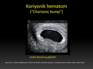 Chorionic Bump Scan ERKEN GEBELİK USG | PDF