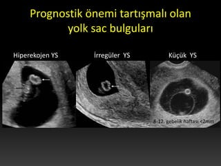 Prognostik önemi tartışmalı olan
yolk sac bulguları
Hiperekojen YS İrregüler YS Küçük YS
8-12. gebelik haftası <2mm
 