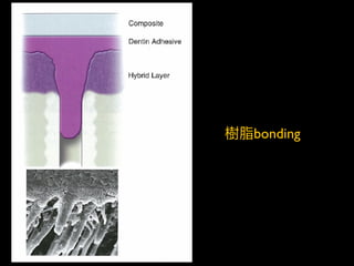 樹脂bonding
 