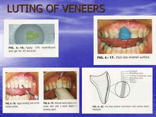 LUTING OF VENEERS
 