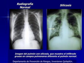 Radiografía Normal Silicosis Imagen del pulmón con silicosis, que muestra el infiltrado  grueso en campos pulmonares diferente al pulmón normal. Departamento de Prevención de Riesgos, Inversiones Quilapilún. 