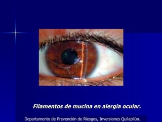 Filamentos de mucina en alergia ocular. Departamento de Prevención de Riesgos, Inversiones Quilapilún. 