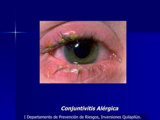 Conjuntivitis Alérgica Departamento de Prevención de Riesgos, Inversiones Quilapilún. Departamento de Prevención de Riesgos, Inversiones Quilapilún. 