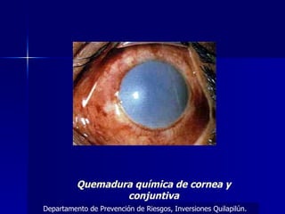 Quemadura química de cornea y conjuntiva Departamento de Prevención de Riesgos, Inversiones Quilapilún. 