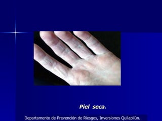 Piel  seca. Departamento de Prevención de Riesgos, Inversiones Quilapilún. 
