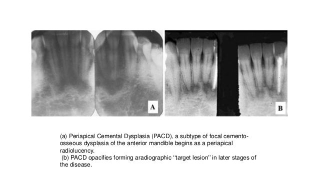 Cemento osseus dysplasia