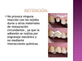 No provoca ninguna reacción con los tejidos duros u otros materiales de restauración circundantes , ya que la adhesión se realiza por engranaje mecánico y no mediante interacciones químicas. 