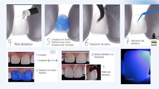 Comprehensive Guide to Dental Cements and Cementation Protocols | PDF