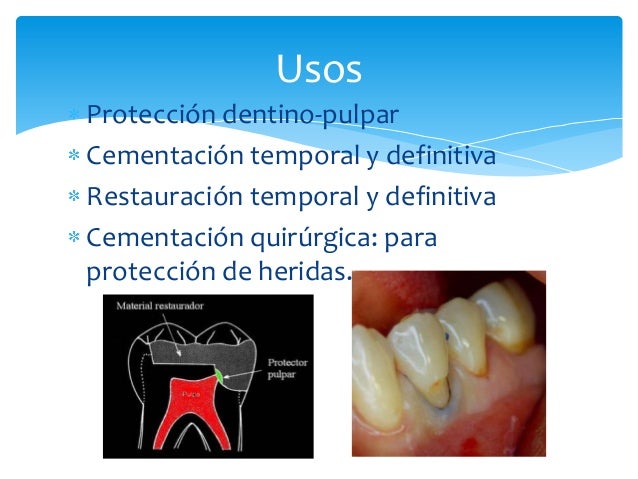 Cementos en odontología