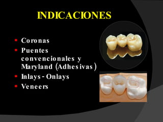 INDICACIONES Coronas Puentes convencionales y Maryland (Adhesivas) Inlays- Onlays Veneers 