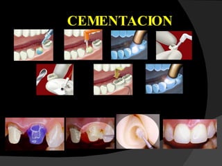 CEMENTACION 