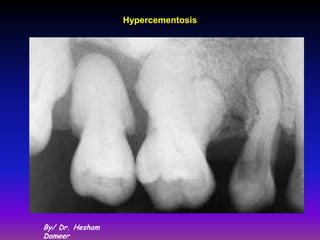 Hypercementosis




By/ Dr. Hesham
Dameer
 