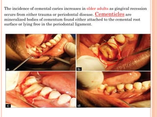 Cementum | PPTX