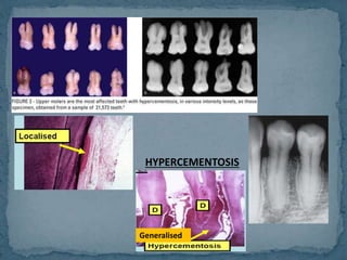 Hypercementosis Roots Radiograph Cementum | PPTX