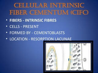 Cellular Intrinsic
Fiber Cementum (CIFC)
• FIBERS - INTRINSIC FIBRES
• CELLS - PRESENT
• FORMED BY - CEMENTOBLASTS
• LOCATION - RESORPTION LACUNAE
 