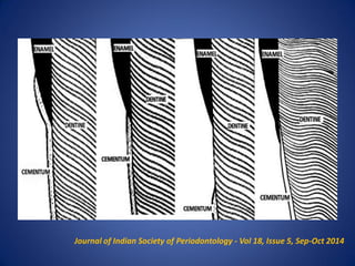 Journal of Indian Society of Periodontology - Vol 18, Issue 5, Sep-Oct 2014
 