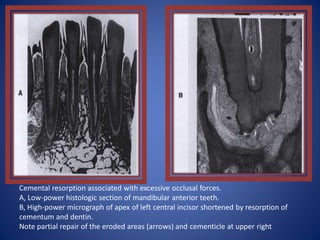 Cemental resorption associated with excessive occlusal forces.
A, Low-power histologic section of mandibular anterior teeth.
B, High-power micrograph of apex of left central incisor shortened by resorption of
cementum and dentin.
Note partial repair of the eroded areas (arrows) and cementicle at upper right
 