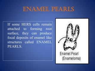 ENAMEL PEARLS
If some HERS cells remain
attached to forming root
surface, they can produce
focal deposits of enamel like
structures called ENAMEL
PEARLS.
 