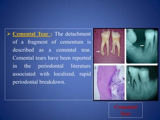  Cemental Tear : The detachment
of a fragment of cementum is
described as a cemental tear.
Cemental tears have been reported
in the periodontal literature
associated with localized, rapid
periodontal breakdown.
Cemental
Tear
 