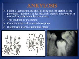 ANKYLOSIS
 Fusion of cementum and alveolar bone and obliteration of the
periodontal ligament is called ankylosis. Results in resorption of
root and its replacement by bone tissue.
 This condition is uncommon.
 Occurs in teeth with cemental resorption.
 It represents a form of abnormal repair.
 