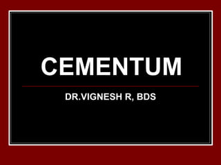 CEMENTUM
DR.VIGNESH R, BDS
 