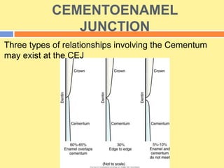 CEMENTOENAMEL
JUNCTION
Three types of relationships involving the Cementum
may exist at the CEJ
 