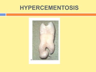 HYPERCEMENTOSIS
 