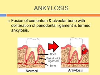 ANKYLOSIS
 Fusion of cementum & alveolar bone with
obliteration of periodontal ligament is termed
ankylosis.
 