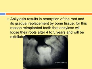  Ankylosis results in resorption of the root and
its gradual replacement by bone tissue; for this
reason reimplanted teeth that ankylose will
loose their roots after 4 to 5 years and will be
exfoliated.
 
