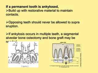 If a permanent tooth is ankylosed,
Build up with restorative material to maintain
contacts.
Opposing teeth should never be allowed to supra
eruption.
If ankylosis occurs in multiple teeth, a segmental
alveolar bone osteotomy and bone graft may be
needed.
 