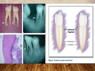 • Cementum forms a functional unit which is designed to
maintain tooth support, integrity, and protection.
• Minor, non-pa...