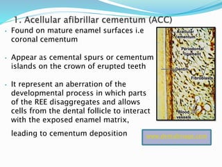 • Found on mature enamel surfaces i.e
coronal cementum
• Appear as cemental spurs or cementum
islands on the crown of erupted teeth
• It represent an aberration of the
developmental process in which parts
of the REE disaggregates and allows
cells from the dental follicle to interact
with the exposed enamel matrix,
leading to cementum deposition www.dentalimage.com
 