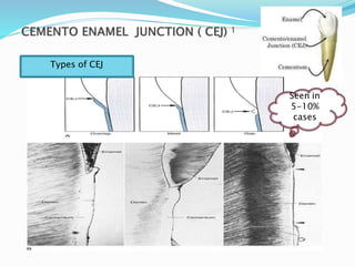 Types of CEJ
Seen in
5-10%
cases
 