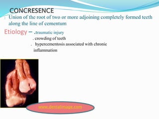  Union of the root of two or more adjoining completely formed teeth
along the line of cementum
Etiology – .traumatic injury
. crowding of teeth
. hypercementosis associated with chronic
inflammation
www.dentalimage.com
 