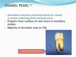  Hemispheric structures consisting entirely of enamel
or contain underlying dentin and pulp tissue
• Projects from surface of root more in maxillary
molars
• Majority in furcation area or CEJ
www.periobasic.com
 