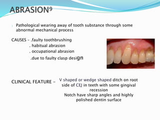  Pathological wearing away of tooth substance through some
abnormal mechanical process
CAUSES – .faulty toothbrushing
. habitual abrasion
. occupational abrasion
.due to faulty clasp design
CLINICAL FEATURE - V shaped or wedge shaped ditch on root
side of CEJ in teeth with some gingival
recession
Notch have sharp angles and highly
polished dentin surface
 