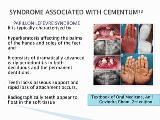 PAPILLON LEFEVRE SYNDROME
 It is typically characterised by:
 hyperkeratosis affecting the palms
of the hands and soles of the feet
and
 It consists of dramatically advanced
early periodontitis in both
deciduous and the permanent
dentitions.
 Teeth lacks osseous support and
rapid loss of attachment occurs.
 Radiographically teeth appear to
float in the soft tissue
Textbook of Oral Medicine, Anil
Govindra Ghom, 2nd edition
 