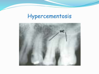 Hypercementosis 
 