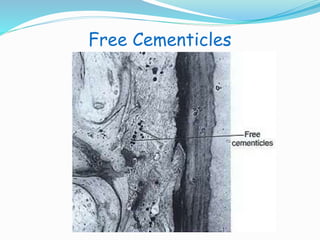 Free Cementicles 
 