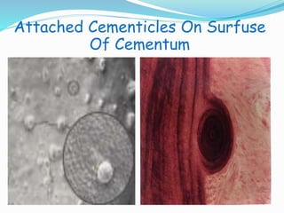 Attached Cementicles On Surfuse 
Of Cementum 
 