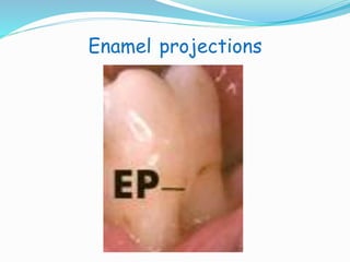 Enamel projections 
 